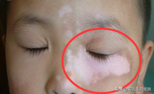 小孩脸上有白斑是啥病？医生：不是肚子“有蛔虫”，警惕这4种病