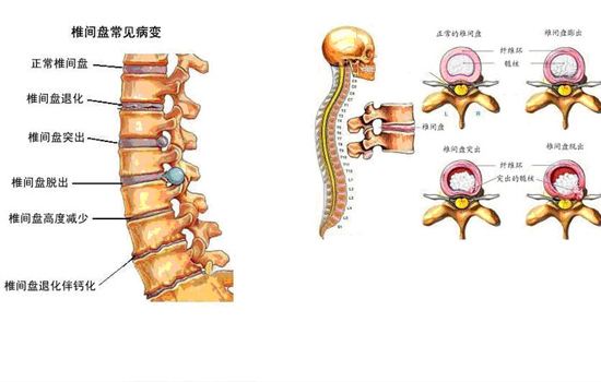 腰椎间盘突出症的治疗方法全集