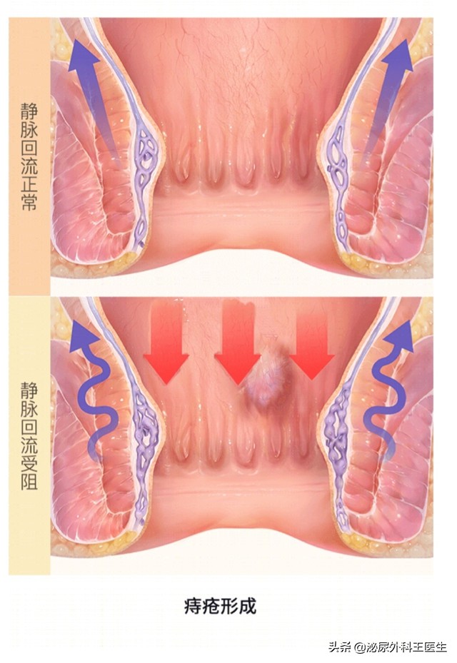 肛门摸到了小肉球，是痔疮还是尖锐湿疣？医生来教你区分