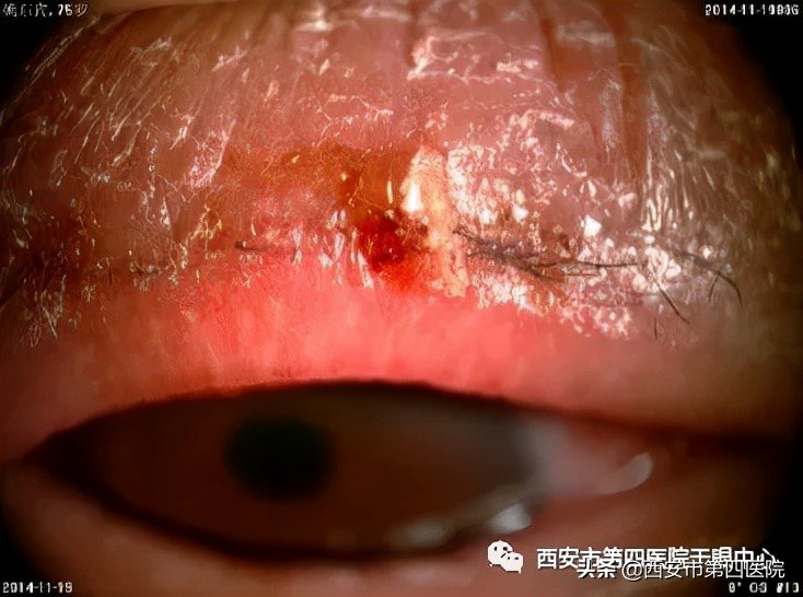 #健康中国行动2030# 总是眼痒、眼干、流泪？三种治疗方式来了解！
