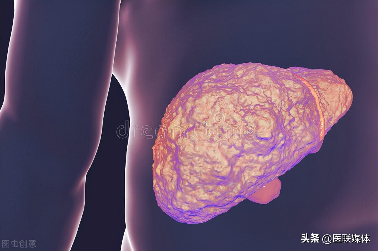 肝硬化是一种很可怕的疾病？这3种并发症，要提前做好预防