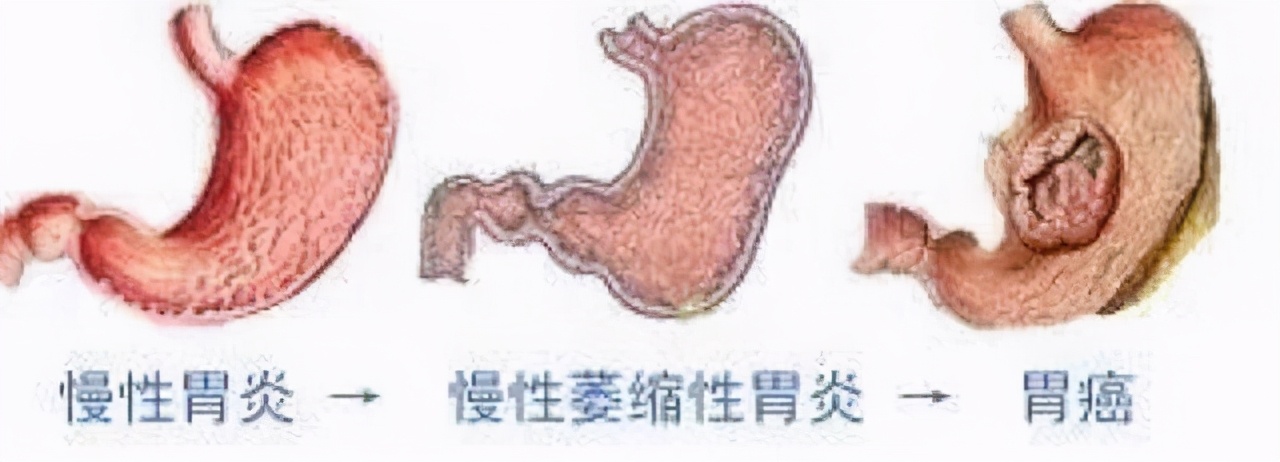 从胃炎到胃癌，一般需要多长时间？医生：有3种症状，尽量不要拖