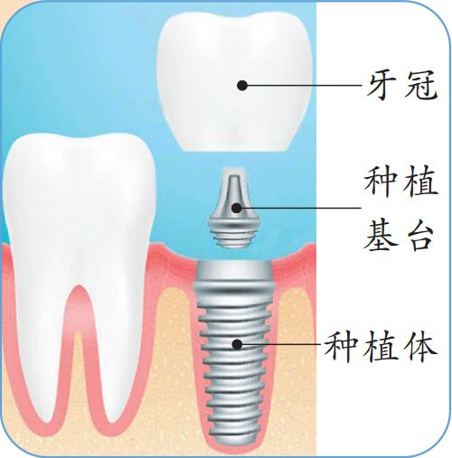 一颗牙成千上万！口腔专家告诉你「种牙」到底贵在哪里