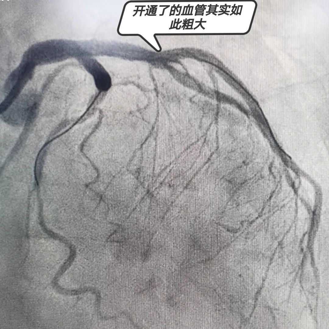 心血管内科为一患者成功实施急性心肌梗死急诊经皮冠脉介入治疗（PCI）
