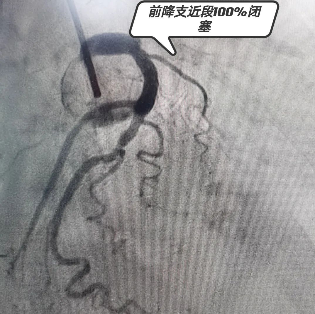 心血管内科为一患者成功实施急性心肌梗死急诊经皮冠脉介入治疗（PCI）