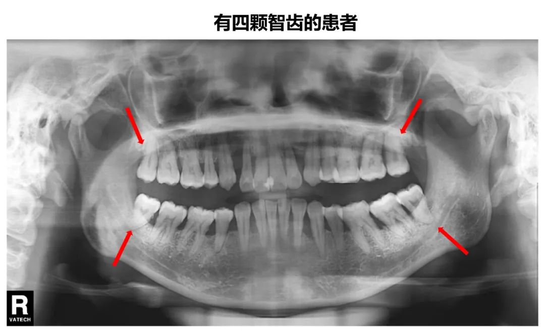 5岁女童拔牙，大出血脑死亡！拔牙前一定要知道的事项，不要不当回事！