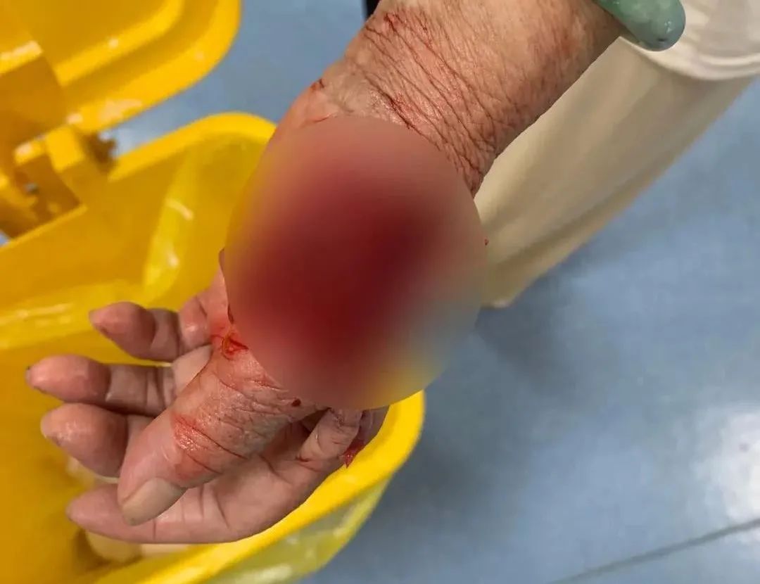 缝针+植皮！北海一妇女被自家狗咬伤，撕裂一大块皮肉