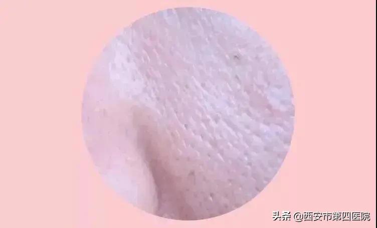 #健康中国行动2030#【变美秘籍】毛孔粗大怎么彻底解决？