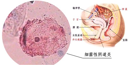 女性各类常见阴道炎的防和治，宅在家里应知道