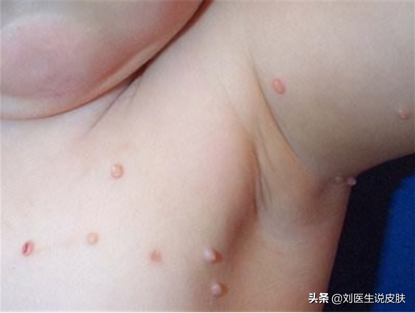 皮肤长小肉疙瘩，可能是这3种类型，情况可轻可重
