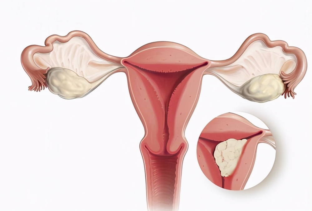 宫角妊娠，罕见的异常妊娠现象，其常用的治疗手段有哪些？