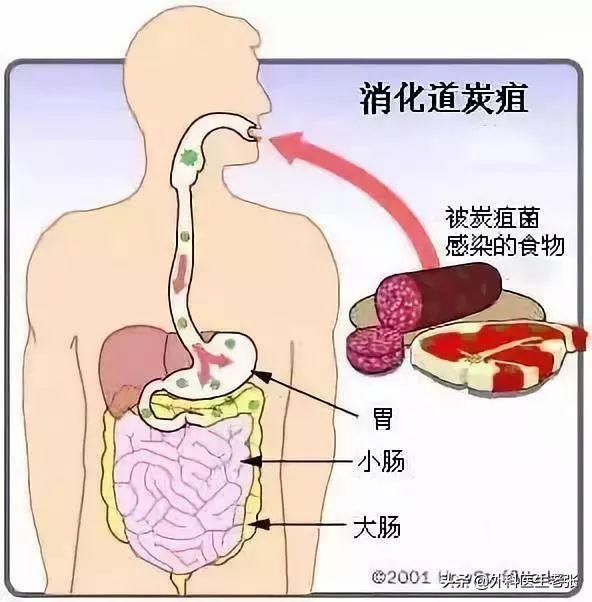 皮肤炭疽病的症状图片