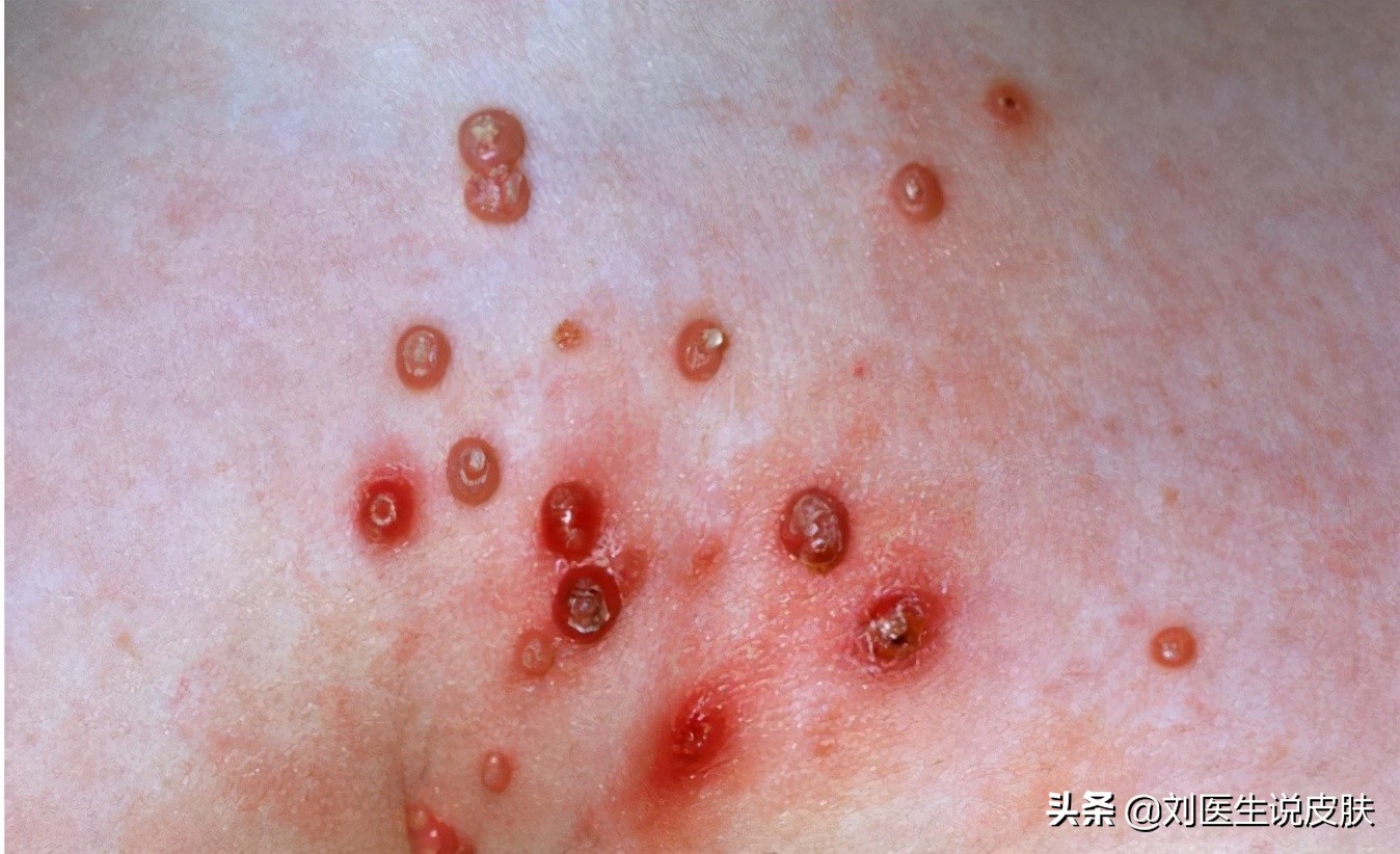 皮肤长小肉疙瘩，可能是这3种类型，情况可轻可重