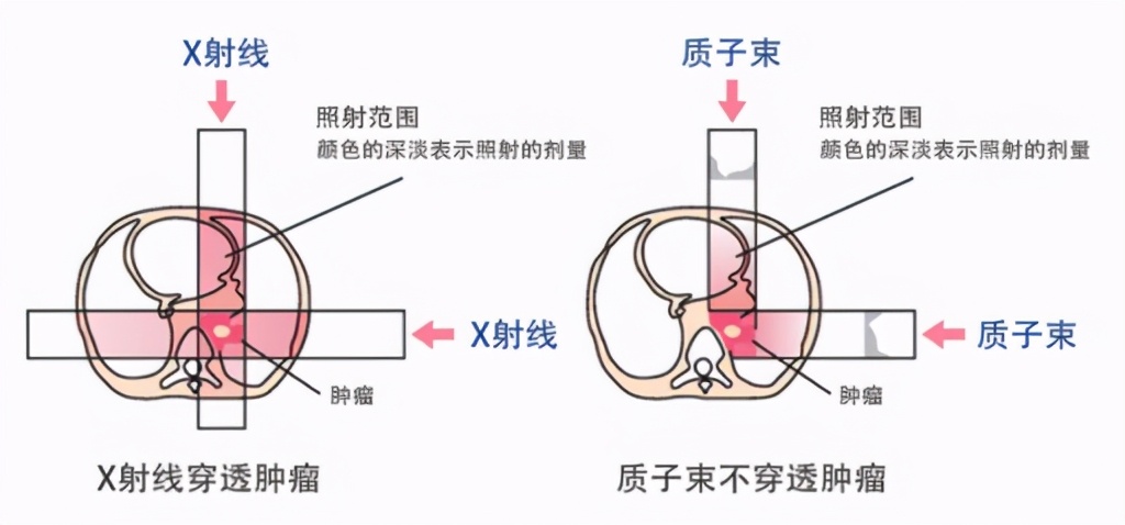 李宗伟癌症治愈，花费近千万？先进抗癌治疗法何时能“白菜价”？