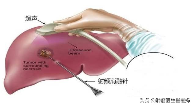 腹痛腹胀食欲差，检查发现竟是癌症晚期，医生：这样做可早诊早治