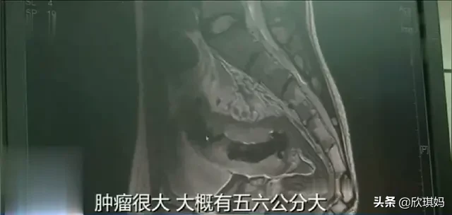 帅小伙每次排便都出血，医生说已经是大肠癌晚期，血掉了一半