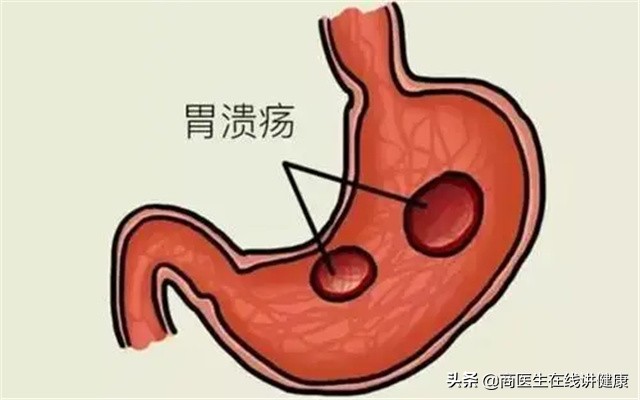 烧心反酸胃难受怎么办？医生：用这2个方法可以得到缓解