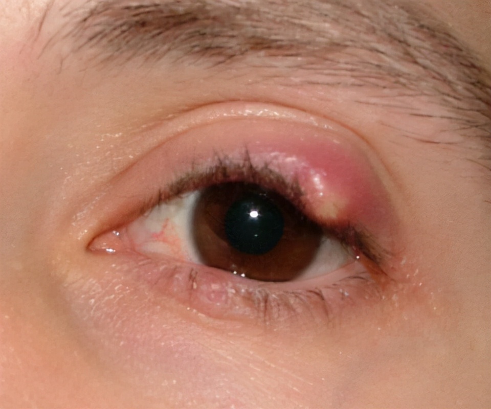 由眼睑腺体急性化脓引发的炎症,有眼部红肿,压痛,异物感等症状