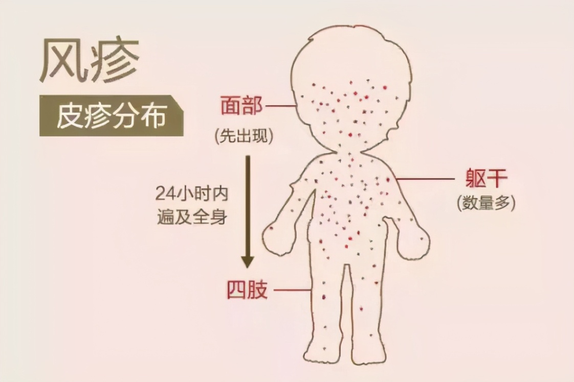 风疹有什么症状，如何预防风疹？