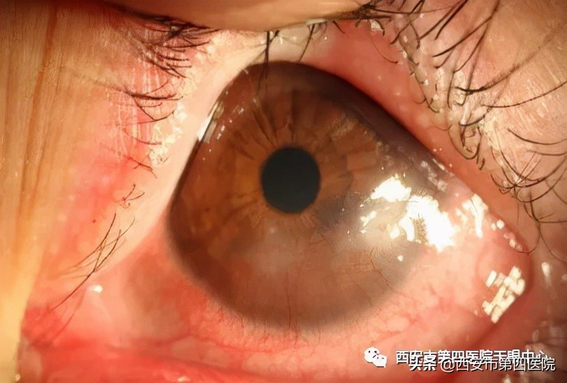 #健康中国行动2030# 总是眼痒、眼干、流泪？三种治疗方式来了解！