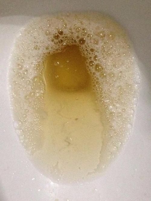尿液中有泡沫是怎么回事？
