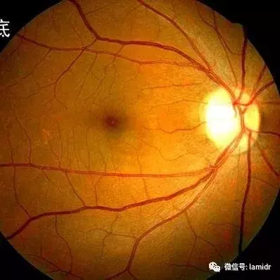 HIV感染,为什么出现眼部症状?