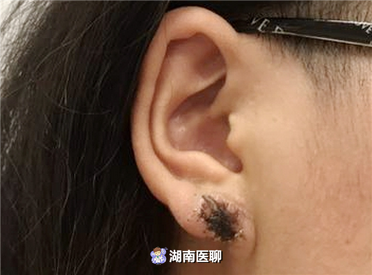 耳垂变肥变厚成“疙瘩”？女子打耳洞后耳朵发痒红肿，懊悔不已
