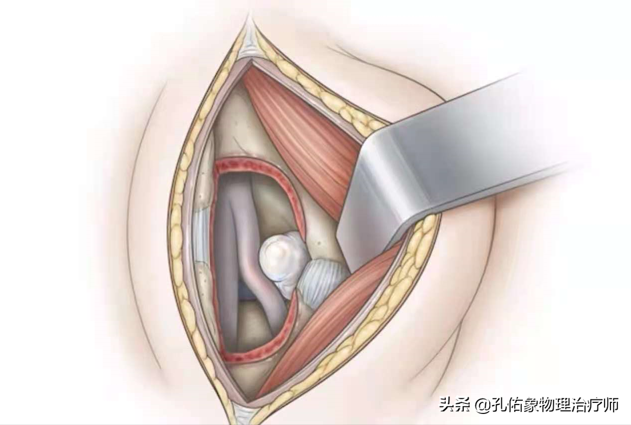 腰椎间盘突出压迫神经了，屁股和腿疼，有什么好的治疗方法？