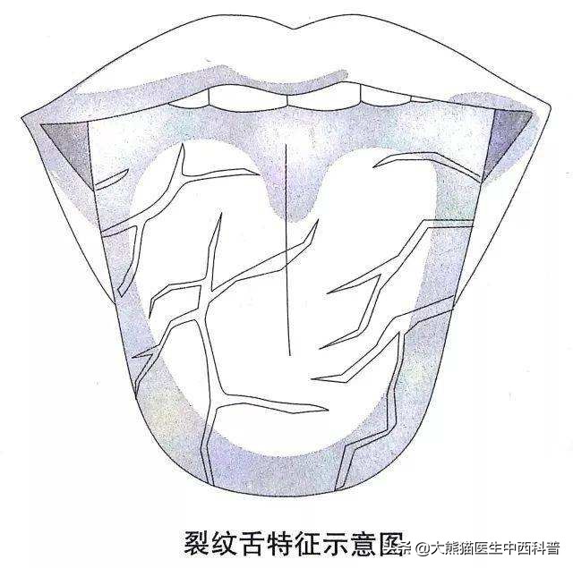 舌头出现裂纹是怎么回事？原因及应对方法解析