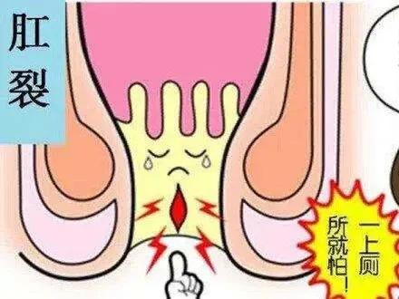 大便带血要小心！！除了痔疮，还可能是这种病