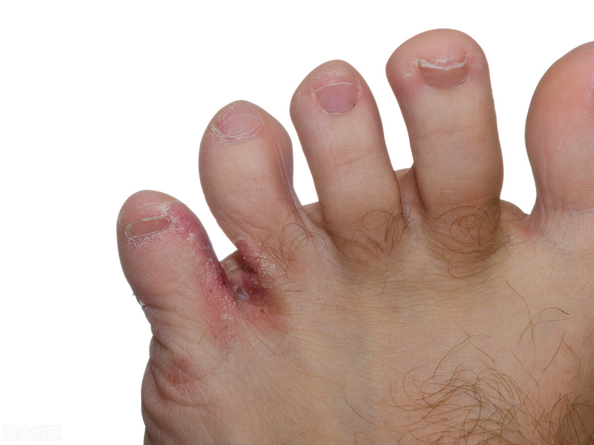 医生教你怎么治理香港脚（脚气、足癣）