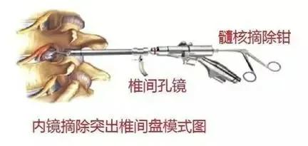 腰痛腿麻怎么办？是椎间盘突出了吗？