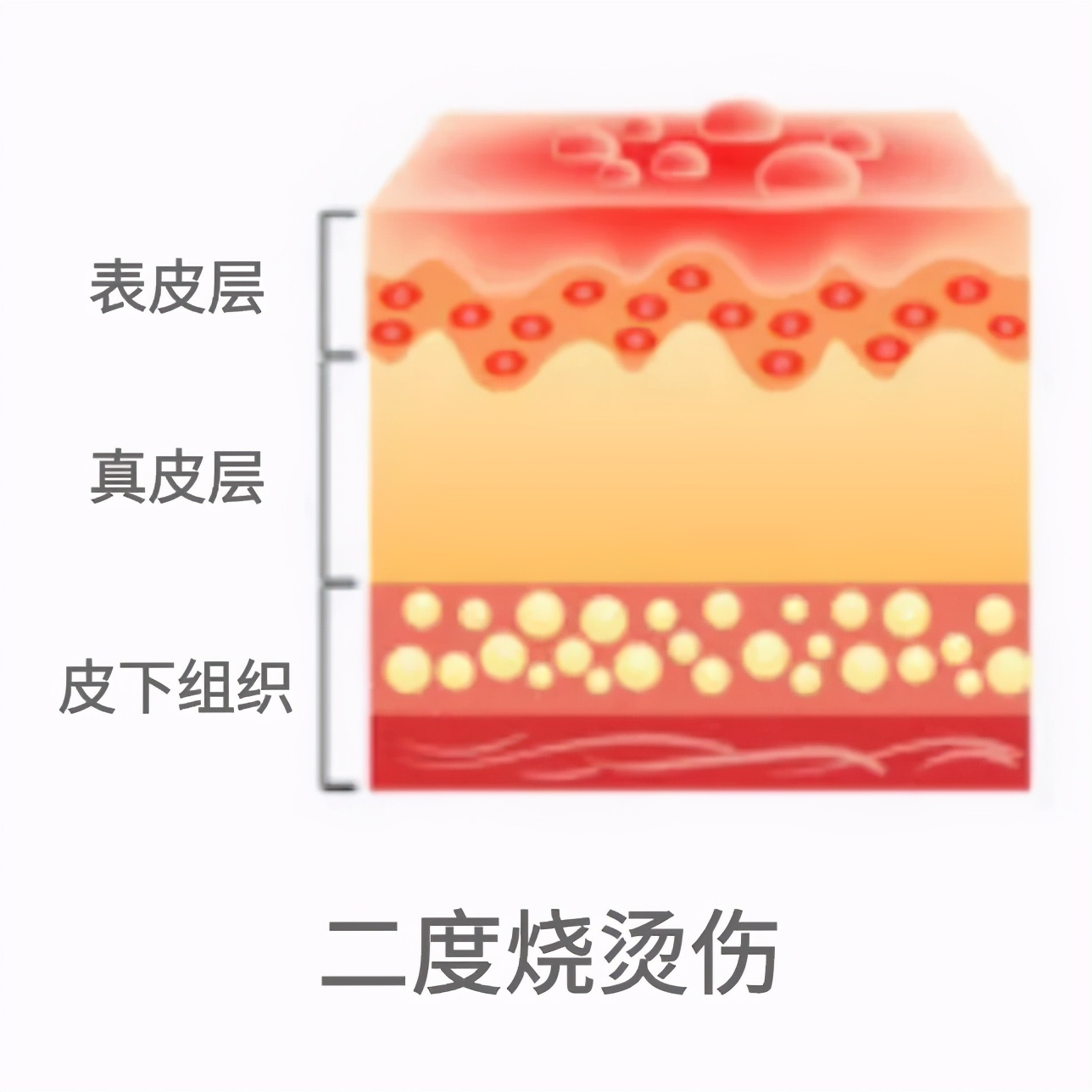 烧伤、烫伤后怎么办？五字诀帮你渡难关
