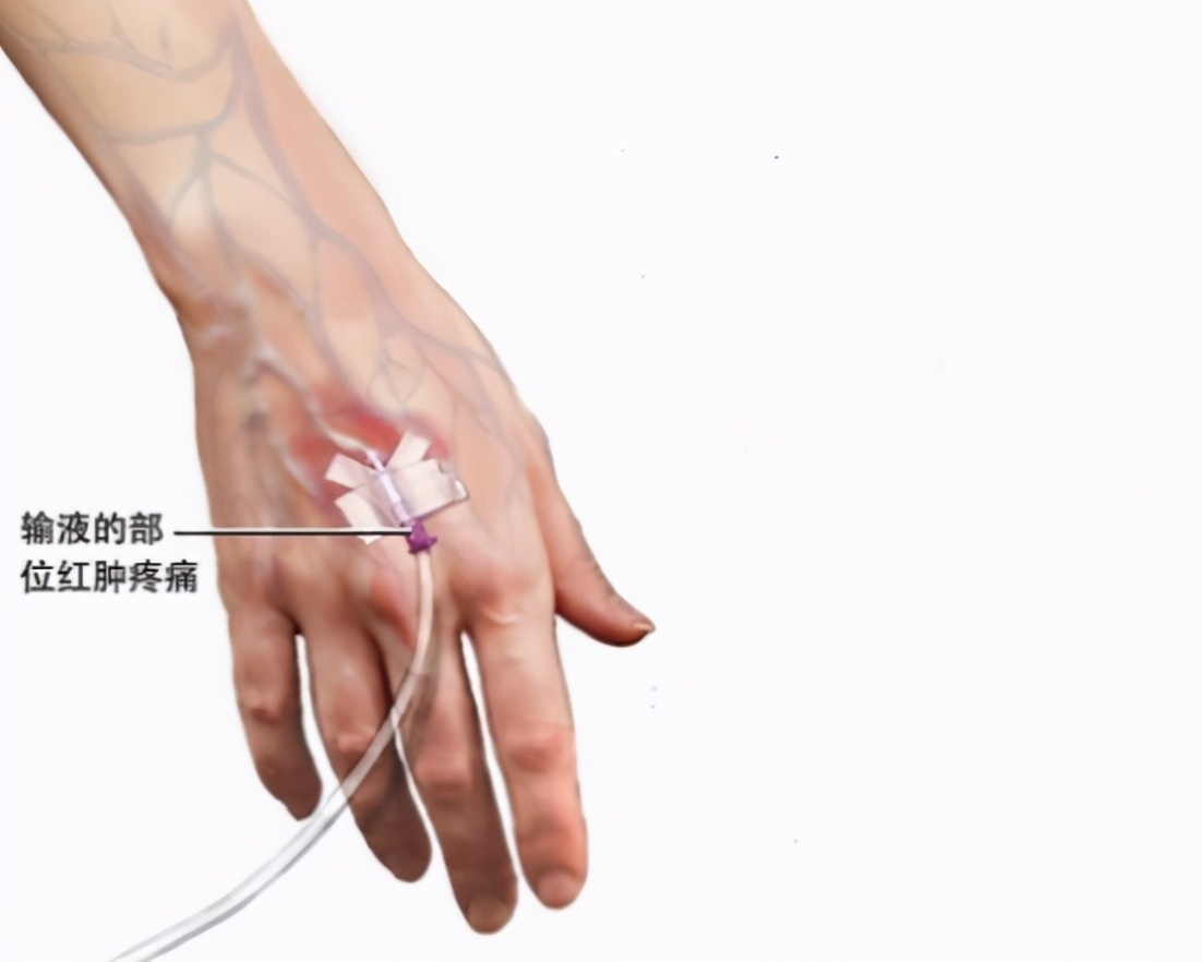 静脉炎的护理与措施以及预防