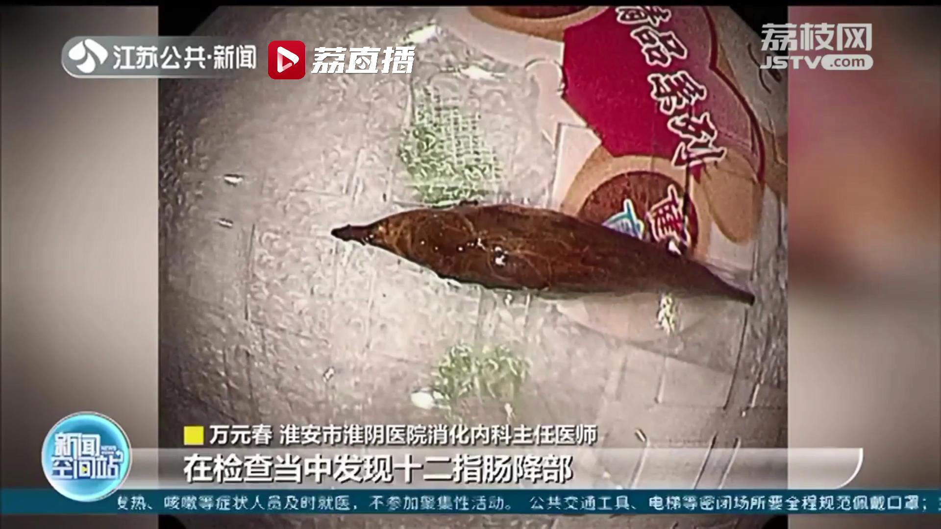 淮安一六旬老人&ldquo;囫囵吞枣&rdquo;后腹痛难忍 医生妙手取出枣核