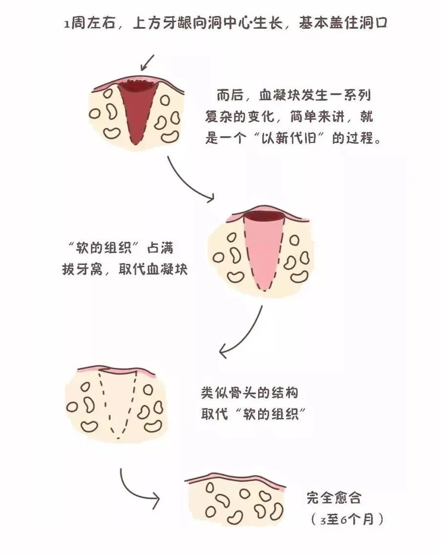 拔牙后最怕的是“牙洞”的恢复期！需要多久才能愈合？