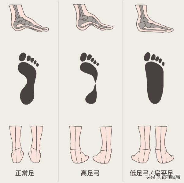 为什么有的人总是崴脚？3 个动作自测踝关节好坏