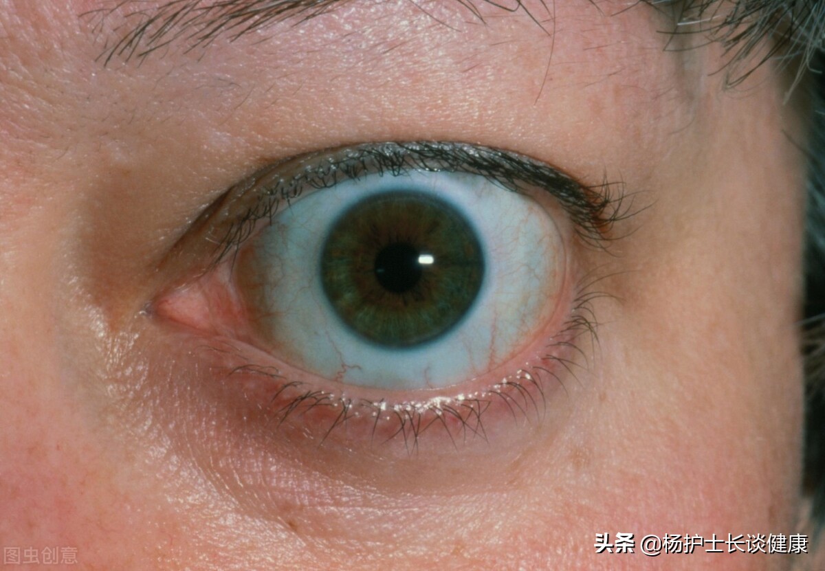 甲状腺功能亢进的人,身体或有3种表现,不妨自查一下