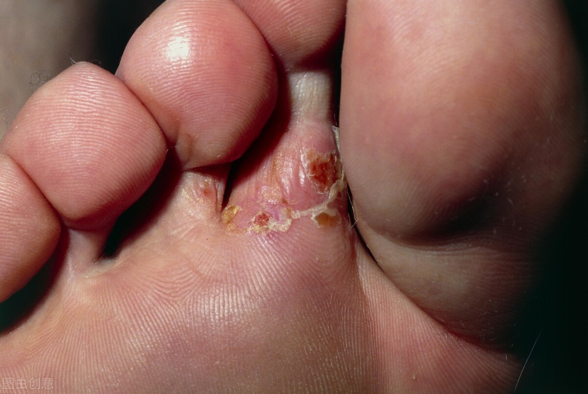 医生教你怎么治理香港脚（脚气、足癣）