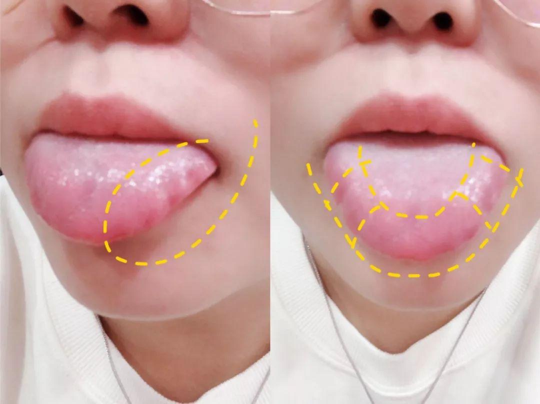 上颌下损伤(子弹损伤),枕髁骨折,脑膜炎,颅底或颈部损伤(如舌下神经