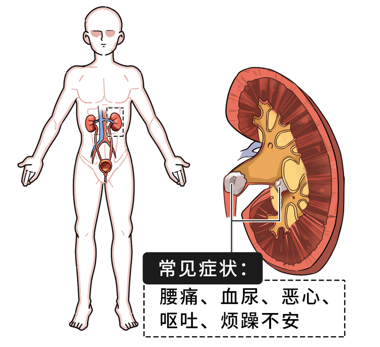 很多结石都是“吃”出来的！这些不良饮食习惯，你中招了吗？