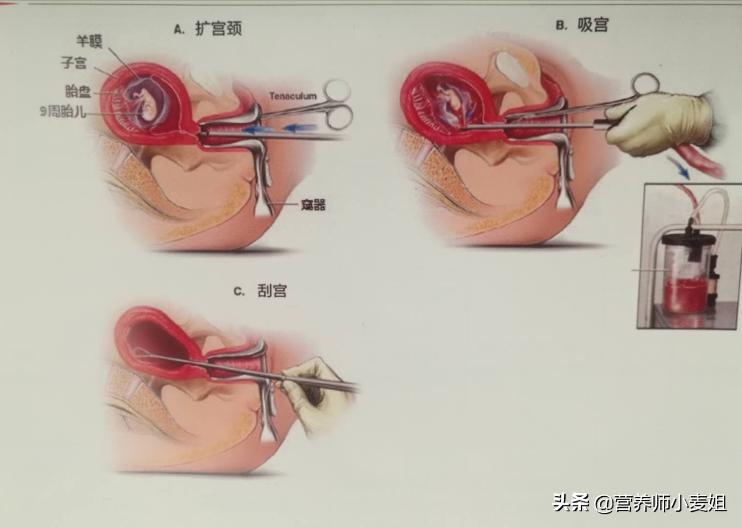 图解人流怎么做？手术后注意什么？你想知道的在这里：人流二十问