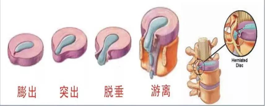 腰痛腿麻怎么办？是椎间盘突出了吗？