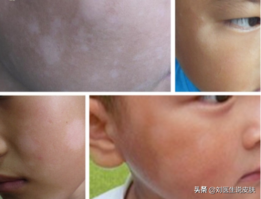 小孩脸上有白斑是啥病？医生：不是肚子“有蛔虫”，警惕这4种病