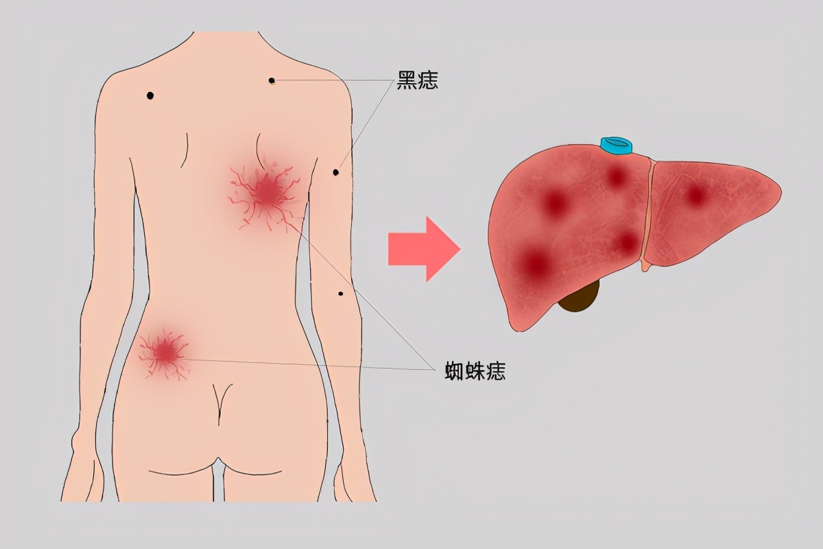 黑痣出现这5个变化，可能发生癌变了，黑色素瘤可不能小看_患者