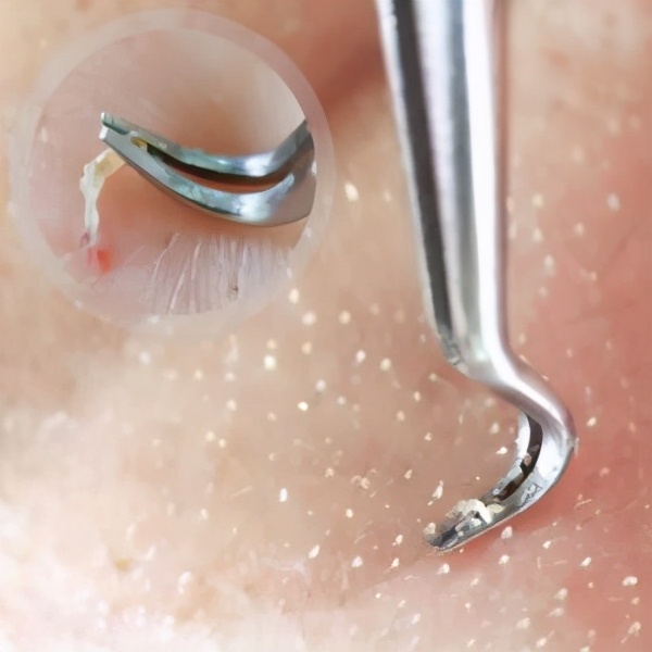 去黑头的最好方法简单又快捷的去黑头小妙招