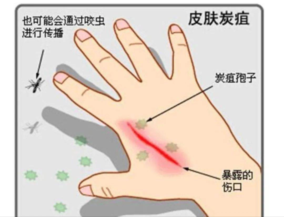 警惕！14岁少年死于炭疽，一月内多地发生疫情，我们该如何防治？