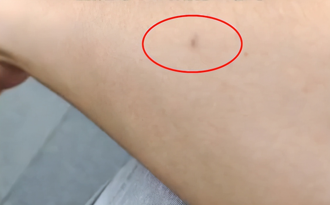 兩網(wǎng)友自稱在廣州街頭被人扎針(圖3)