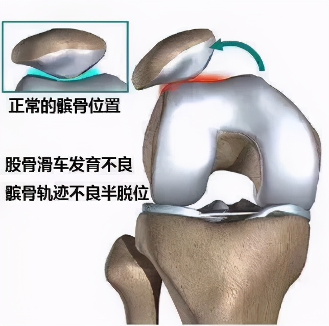 不同位置的膝盖疼，预示着不同的疾病！骨科医师的一张图，教你秒懂