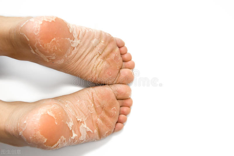 医生教你怎么治理香港脚（脚气、足癣）